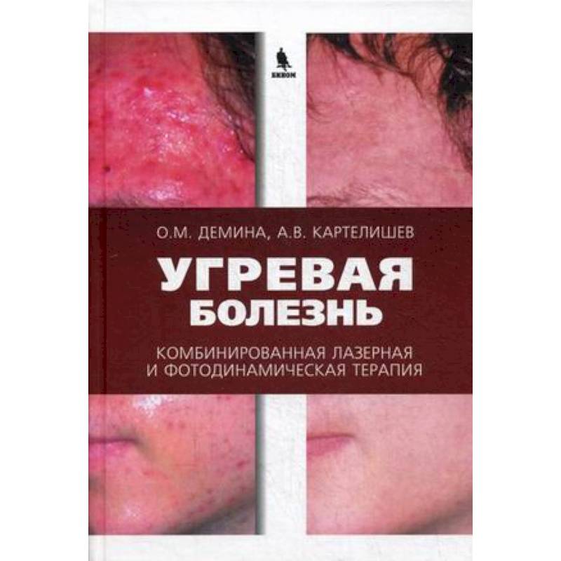 Угревая болезнь. Комбинированная лазерная и фотодинамическая терапия