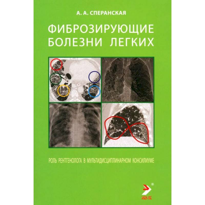 Фиброзирующие болезни легких. Роль рентгенолога в мультидисциплинарном консилиуме Фиброзирующие болезни легких. Роль рентгенолога в мультидисциплинарном консилиуме