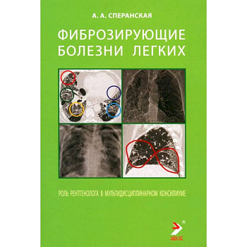 Фиброзирующие болезни легких. Роль рентгенолога в мультидисциплинарном консилиуме Фиброзирующие болезни легких. Роль рентгенолога в мультидисциплинарном консилиуме