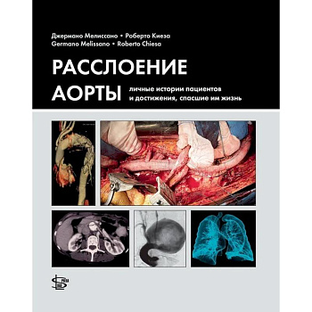 Расслоение аорты. Личные истории пациентов и достижения, спасшие им жизнь Расслоение аорты. Личные истории пациентов и достижения, спасшие им жизнь